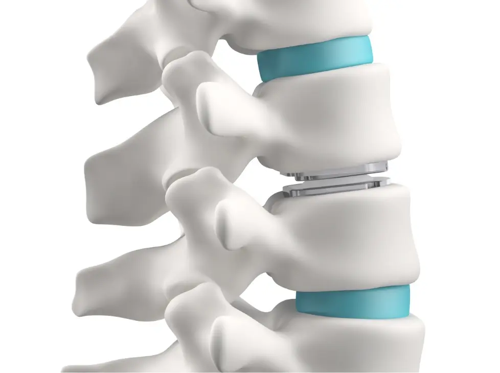 Prodisc® L Lumbar Disc Replacement