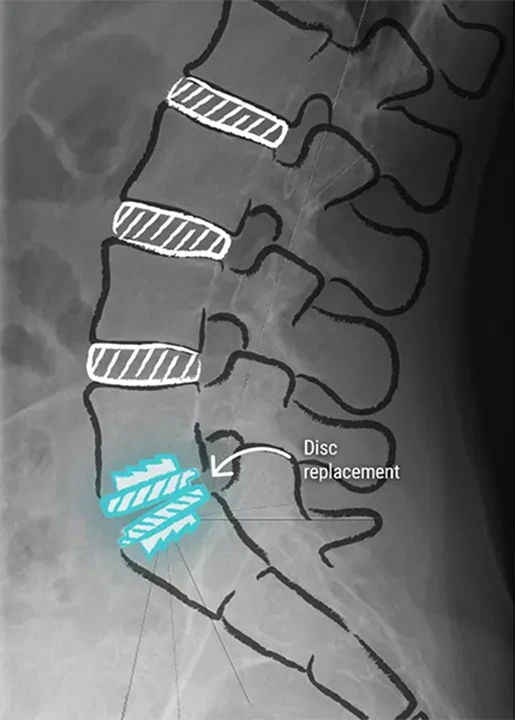 Diagram showing the location of a disc replacement