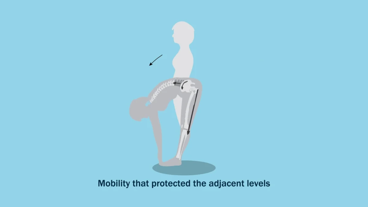 spinepro long term prodisc outcomes study video thumbnail